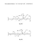 Devices for Clearing Blockages in Artificial and Natural Lumens diagram and image