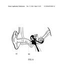 COCHLEA HEARING AID FIXED ON EARDRUM diagram and image