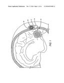 Cortical Visual Prosthesis diagram and image