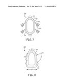 MINIMALLY INVASIVE IMPLANTABLE NEUROSTIMULATION SYSTEM diagram and image