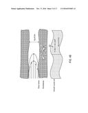 RENAL INJURY INHIBITING DEVICES, SYSTEMS, AND METHODS EMPLOYING     LOW-FREQUENCY ULTRASOUND OR OTHER CYCLICAL PRESSURE ENERGIES diagram and image