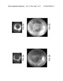 RENAL INJURY INHIBITING DEVICES, SYSTEMS, AND METHODS EMPLOYING     LOW-FREQUENCY ULTRASOUND OR OTHER CYCLICAL PRESSURE ENERGIES diagram and image