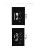 RENAL INJURY INHIBITING DEVICES, SYSTEMS, AND METHODS EMPLOYING     LOW-FREQUENCY ULTRASOUND OR OTHER CYCLICAL PRESSURE ENERGIES diagram and image