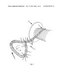 More Versatile Self-Bonding Cords diagram and image