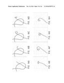 MULTI-POLE SYNCHRONOUS PULMONARY ARTERY RADIOFREQUENCY ABLATION CATHETER diagram and image