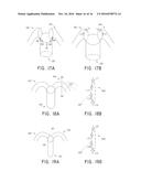 MULTI-POLE SYNCHRONOUS PULMONARY ARTERY RADIOFREQUENCY ABLATION CATHETER diagram and image