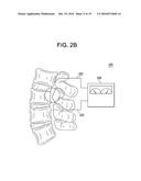 METHODS AND DEVICES FOR SPINAL CORRECTION diagram and image