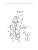 METHODS AND DEVICES FOR SPINAL CORRECTION diagram and image