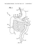 INCISIONLESS GASTRIC BYPASS METHOD & DEVICES diagram and image