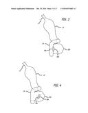 INCISIONLESS GASTRIC BYPASS METHOD & DEVICES diagram and image