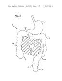 INCISIONLESS GASTRIC BYPASS METHOD & DEVICES diagram and image