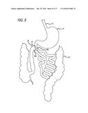 INCISIONLESS GASTRIC BYPASS METHOD & DEVICES diagram and image