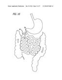 INCISIONLESS GASTRIC BYPASS METHOD & DEVICES diagram and image