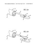 INCISIONLESS GASTRIC BYPASS METHOD & DEVICES diagram and image