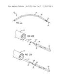 INCISIONLESS GASTRIC BYPASS METHOD & DEVICES diagram and image