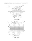 SURGICAL IMPLANT AND METHOD AND INSTRUMENT FOR INSTALLING THE SAME diagram and image