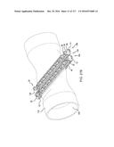 SURGICAL IMPLANT AND METHOD AND INSTRUMENT FOR INSTALLING THE SAME diagram and image