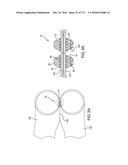 SURGICAL IMPLANT AND METHOD AND INSTRUMENT FOR INSTALLING THE SAME diagram and image