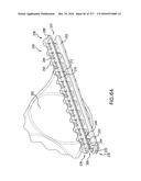 SURGICAL IMPLANT AND METHOD AND INSTRUMENT FOR INSTALLING THE SAME diagram and image