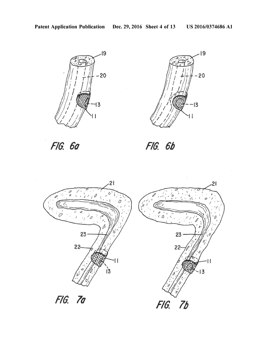 PARTIAL CUFF - diagram, schematic, and image 05