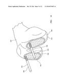 SYSTEM FOR USE IN KNEE SURGERY diagram and image