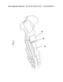 BONE IMPLANTS AND CUTTING APPARATUSES AND METHODS diagram and image