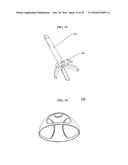 BONE IMPLANTS AND CUTTING APPARATUSES AND METHODS diagram and image