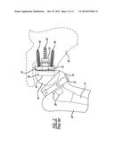 Patient-Specific Humeral Guide Designs diagram and image