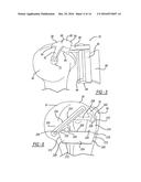 PATIENT-SPECIFIC HUMERAL GUIDE DESIGNS diagram and image