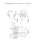 CAROTID BODY ABLATION WITH A TRANSVENOUS ULTRASOUND IMAGING AND ABLATION     CATHETER diagram and image