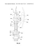 CAROTID BODY ABLATION WITH A TRANSVENOUS ULTRASOUND IMAGING AND ABLATION     CATHETER diagram and image