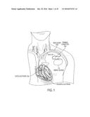 LEAD EXTRACTION METHODS AND APPARATUS diagram and image