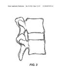 FACET JOINT PROSTHESIS diagram and image