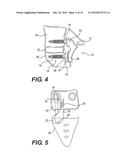 FACET JOINT PROSTHESIS diagram and image