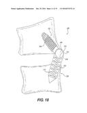 FACET JOINT PROSTHESIS diagram and image