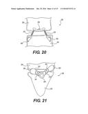 FACET JOINT PROSTHESIS diagram and image