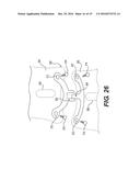 FACET JOINT PROSTHESIS diagram and image