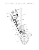 INSERTER AND METHOD FOR SECURING AN IMPLANT TO A SPINAL PROCESS WITH A     FLEXIBLE FASTENING SYSTEM diagram and image