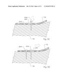 Combined Intramedullary and Extramedullary Surgical Aiming System And     Method diagram and image