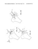 DELIVERY SYSTEM AND METHOD FOR DELIVERING MATERIAL TO A TARGET SITE DURING     A MEDICAL PROCEDURE diagram and image