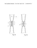 METHOD FOR CONTROLLING FLOW OF INTESTINAL CONTENTS IN A PATIENT S     INTESTINES diagram and image