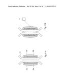 METHOD FOR CONTROLLING FLOW OF INTESTINAL CONTENTS IN A PATIENT S     INTESTINES diagram and image