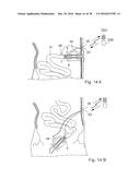 METHOD FOR CONTROLLING FLOW OF INTESTINAL CONTENTS IN A PATIENT S     INTESTINES diagram and image