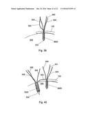 MULTIPLE IMPLANT CONSTRUCTIONS AND FIXATION METHODS ASSOCIATED THEREWITH diagram and image