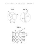 PROSTHETIC HEART VALVE diagram and image