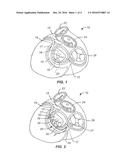 TISSUE SHAPING DEVICE diagram and image