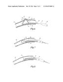 TISSUE SHAPING DEVICE diagram and image