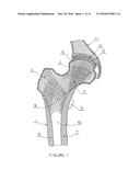 PARTIAL HIP PROSTHESIS diagram and image