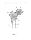 PARTIAL HIP PROSTHESIS diagram and image