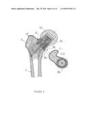 PARTIAL HIP PROSTHESIS diagram and image